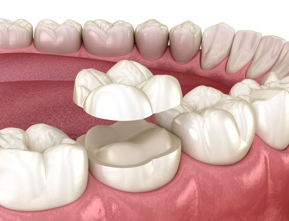 Dental bridge on lower molars between white teeth and pink gums, shown in a close-up mouth illustration
