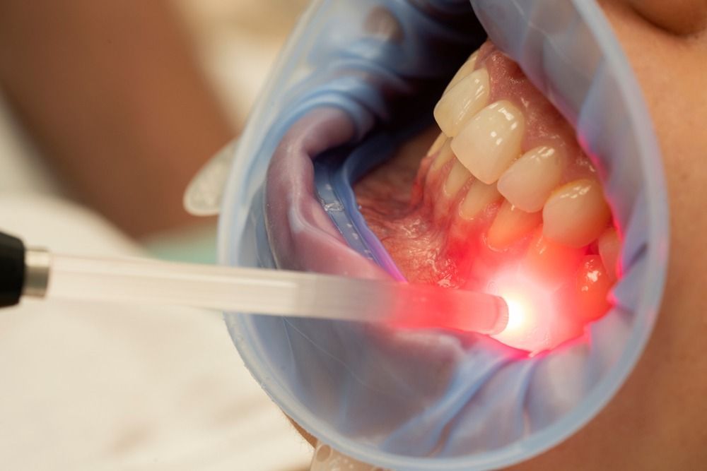 Dental laser treatment on gums inside a patient's open mouth, with a red laser beam.