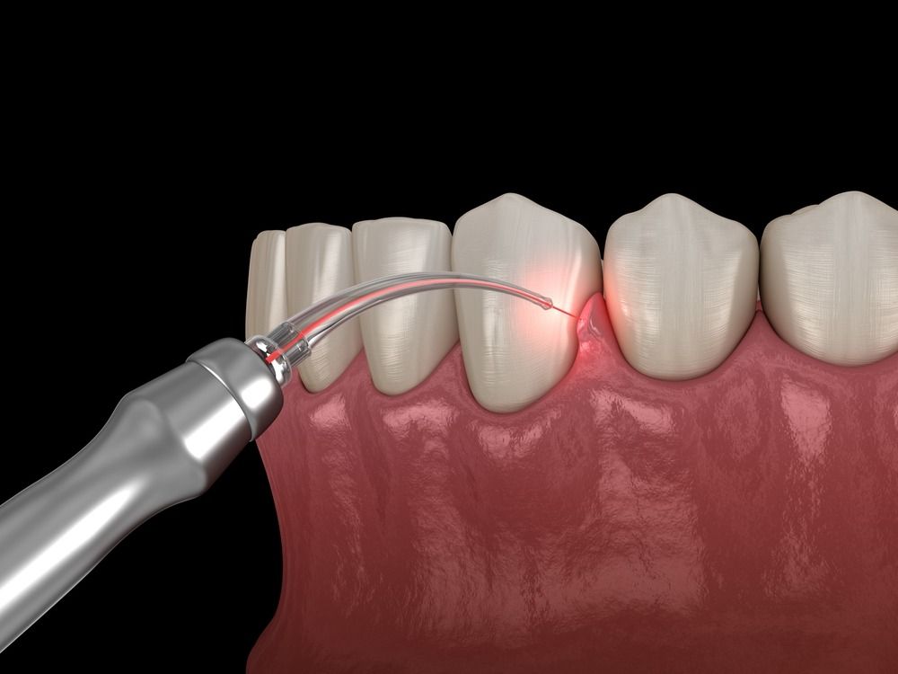 Dental scaler cleaning plaque from teeth along the gumline, with a red irritated spot.