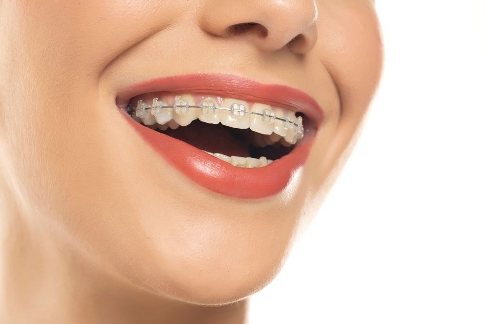 Close-up of a smiling mouth with red lipstick, showing teeth and braces