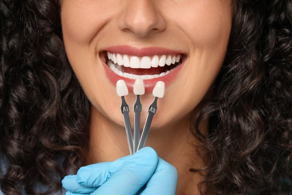 Person with open smile holding three white dental veneers with tweezers near teeth