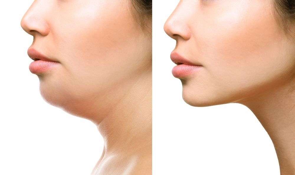 Side-profile comparison of a woman’s chin and neck