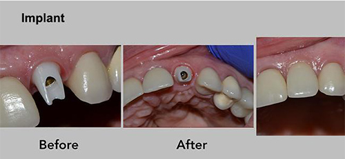Dental implant before-and-after photos showing a front tooth replacement in the upper mouth