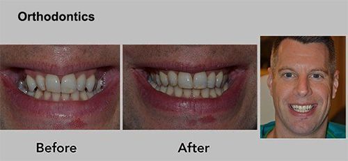 Orthodontics before-and-after smile photos showing straighter teeth and a smiling man