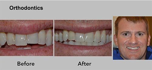 Orthodontics before-and-after photos of teeth with a smiling portrait on the right