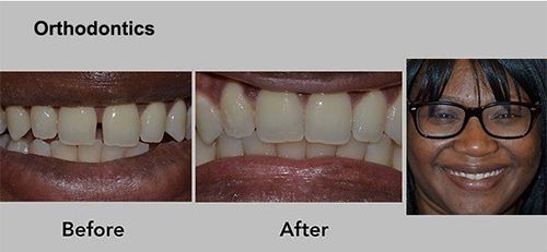 Orthodontics before-and-after smile photos with teeth aligned; smiling woman at right