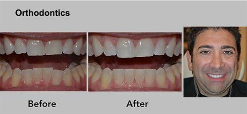 Orthodontics before-and-after teeth alignment comparison with a smiling man portrait