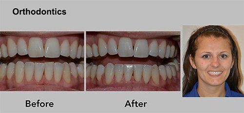 Orthodontics before-and-after teeth alignment photos with a smiling patient portrait