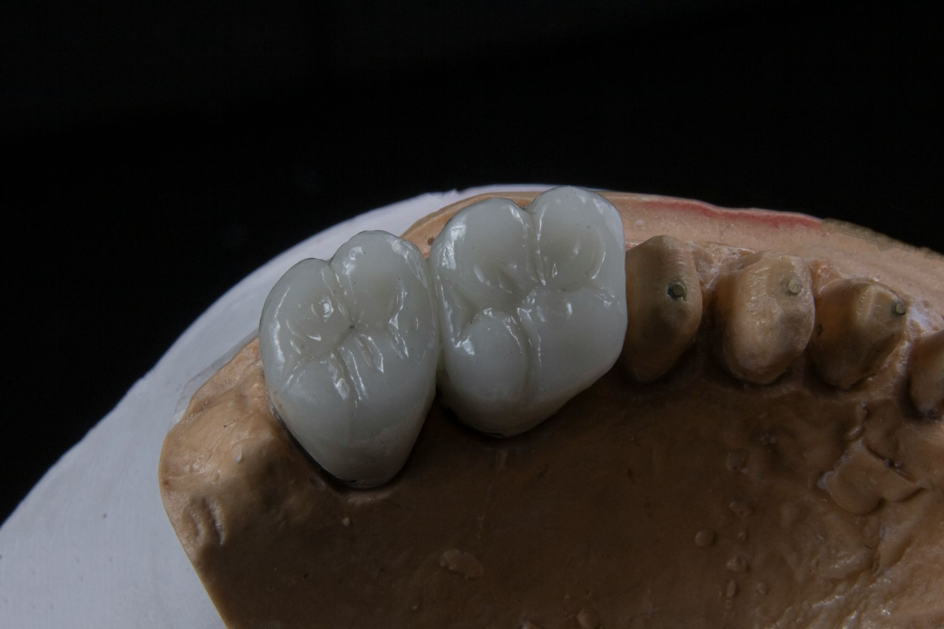 Dental model with two white crowns on a row of tan teeth.