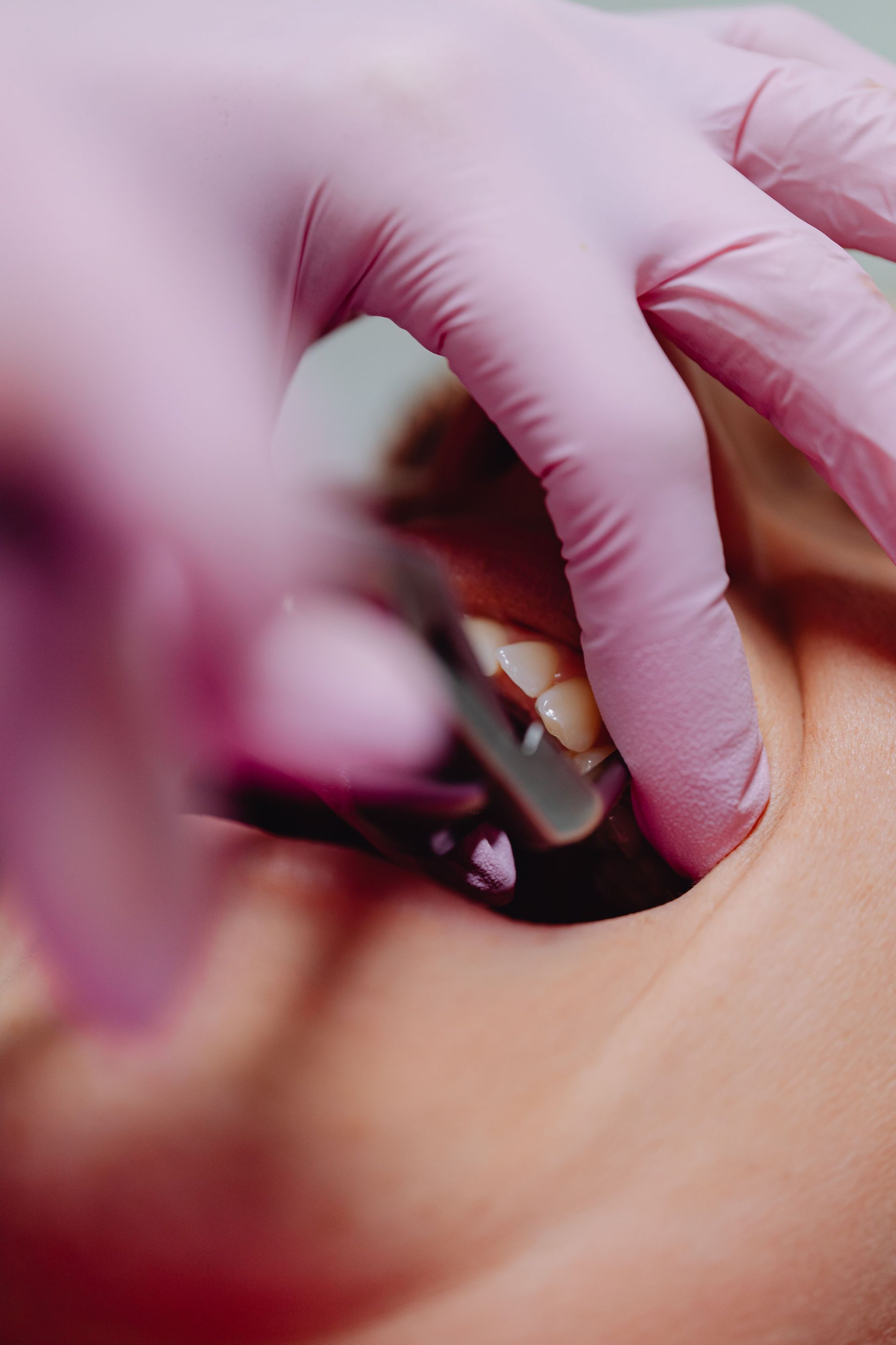 Close-up of gloved hands using dental tools inside a patient’s mouth.