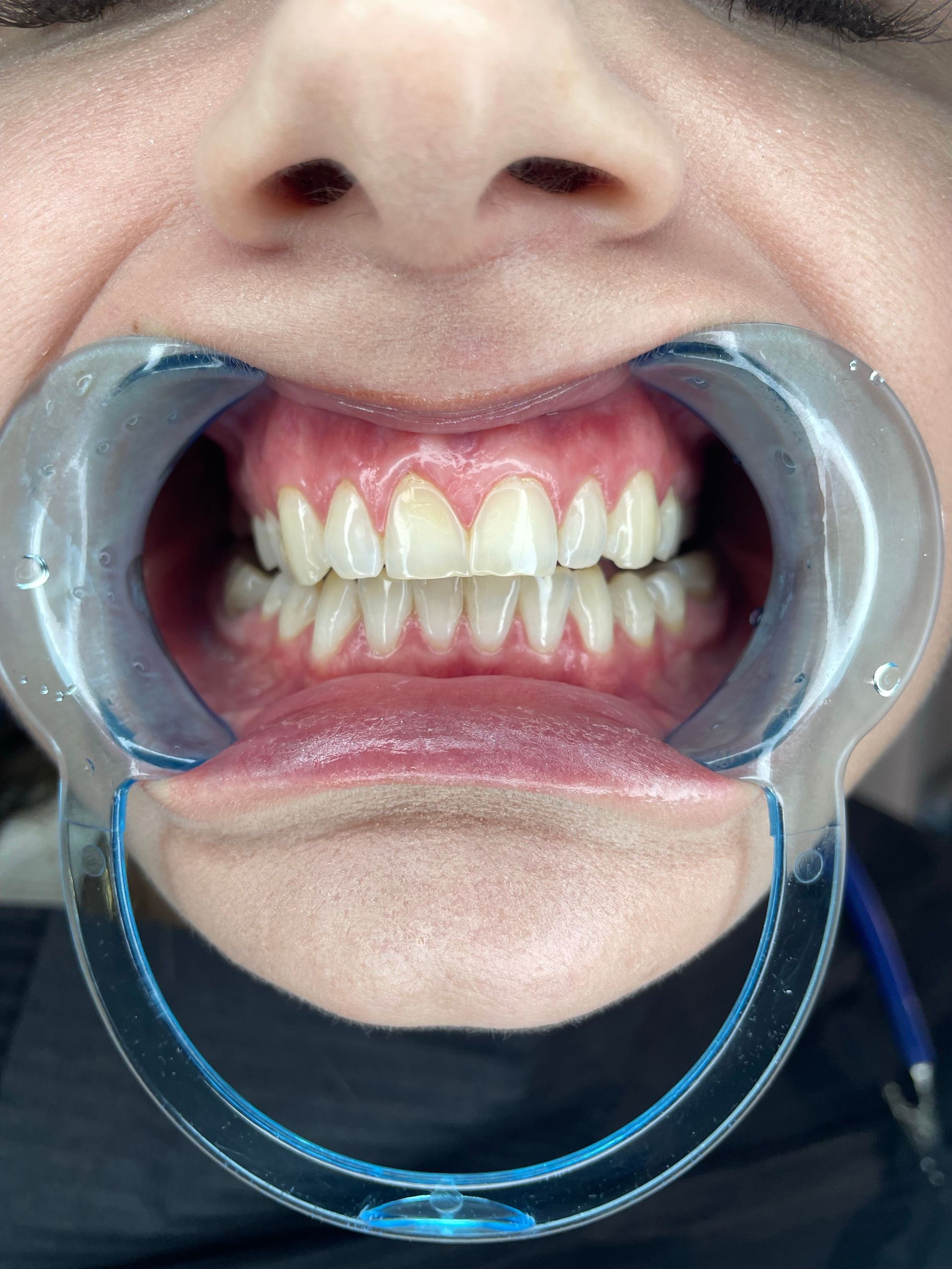Close-up of a mouth held open with a blue dental cheek retractor, showing teeth and gums.