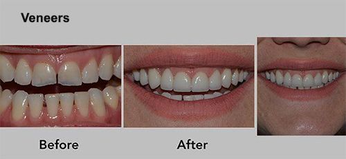 Veneers before-and-after smile comparison showing straighter, whiter teeth