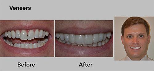 Veneers before-and-after smile photos with a man’s portrait on the right