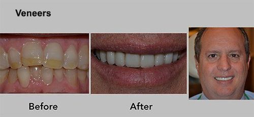 Before-and-after dental veneers: crooked yellow teeth changed to a bright, even smile, with a man’s face beside them