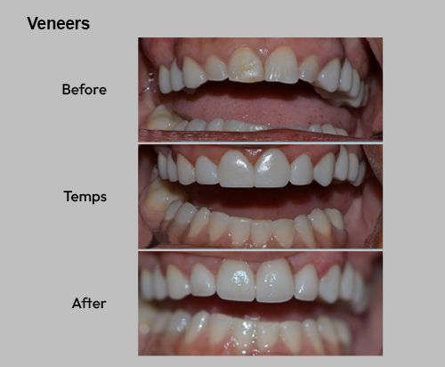 Veneers before, temporary, and after photos of upper teeth showing whitening and alignment improvement
