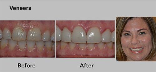 Dental veneers before-and-after comparison showing whiter, straighter teeth and a smiling woman.