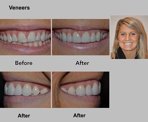 Before-and-after close-ups of teeth with veneers, showing whiter, straighter smiles.