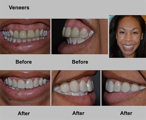 Veneers before-and-after dental photos showing improved teeth alignment and brightness