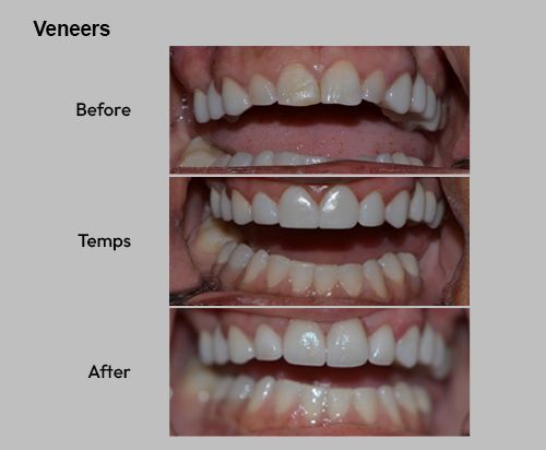 Veneers before, temporary teeth, and after close-up showing whiter, aligned teeth.