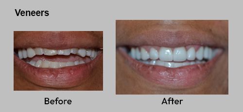 Veneers before-and-after smile comparison showing whiter, straighter teeth after treatment