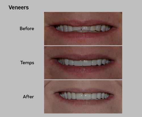 Before, temps, and after close-up of teeth veneers showing whiter, straighter smile progressions