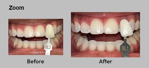 Side-by-side before and after close-ups of teeth with a front tooth restoration