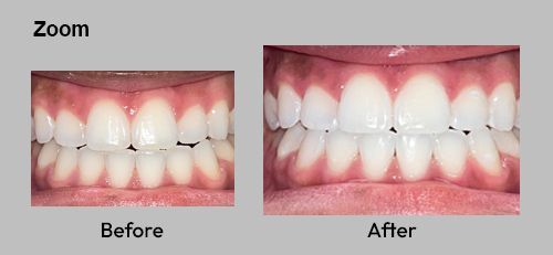 Before-and-after close-up of teeth whitening, with brighter teeth in the after image.