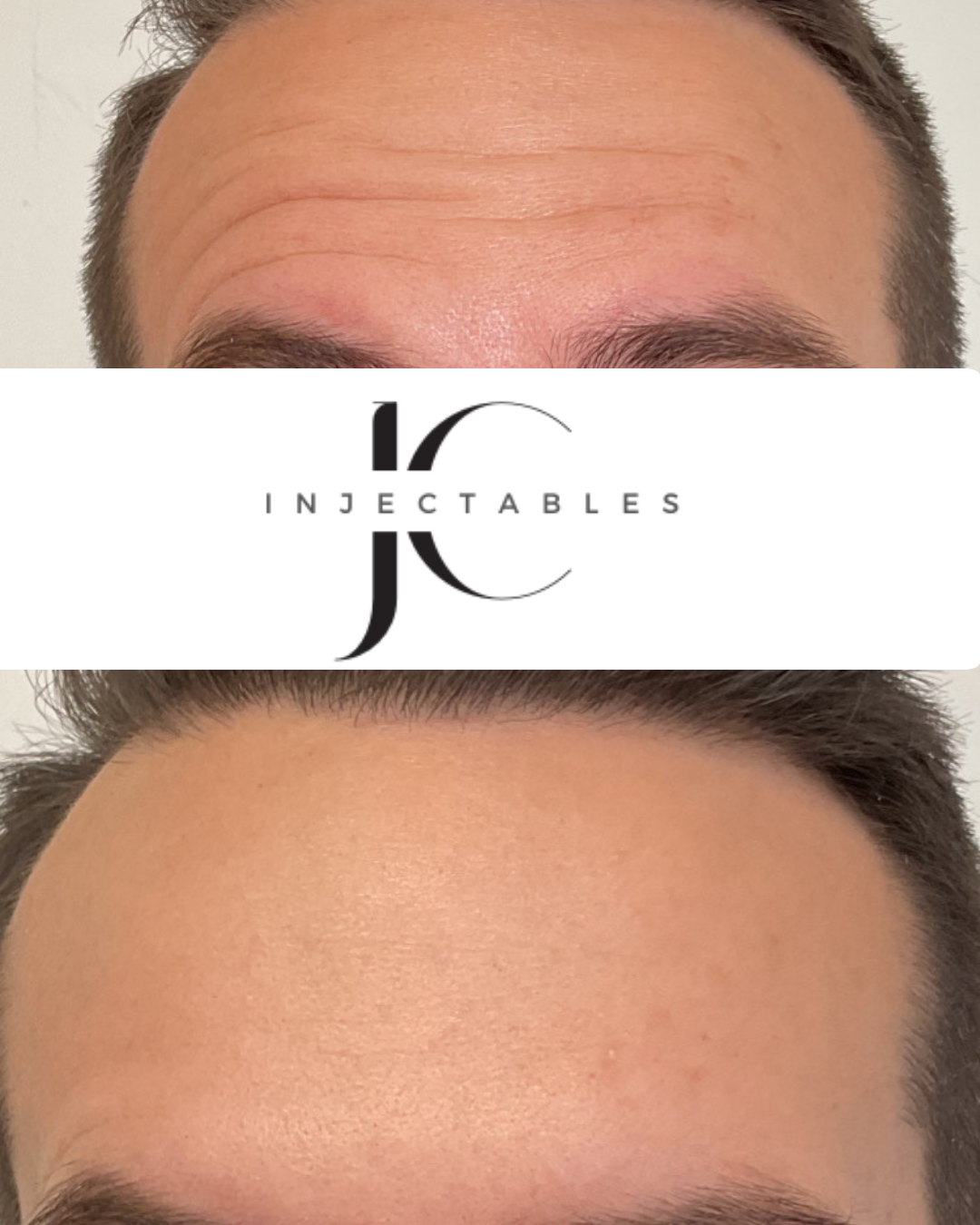 AntiWrinkle Treatments JC Injectables Auckland — free download