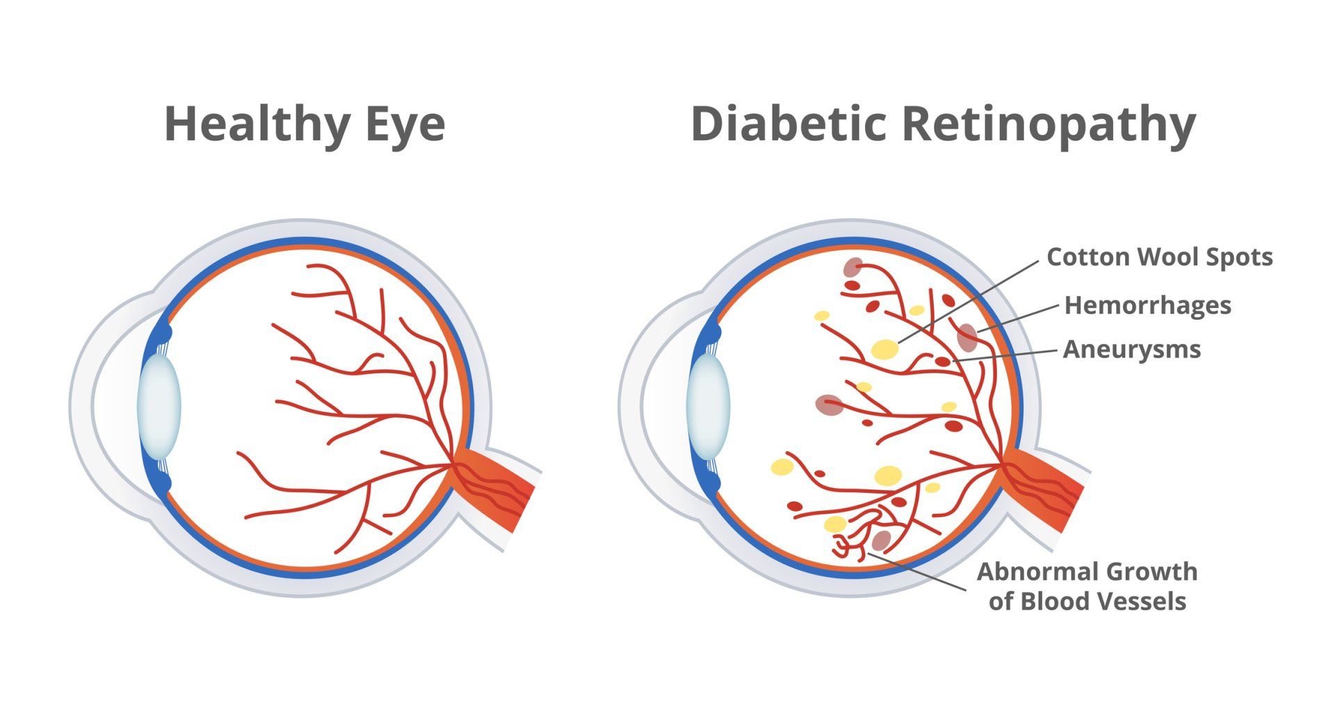 Diabetic Retinopathy — Tupelo, MS — Tupelo Eye Center Diabetic Retinopathy — Tupelo, MS — Tupelo Eye Center