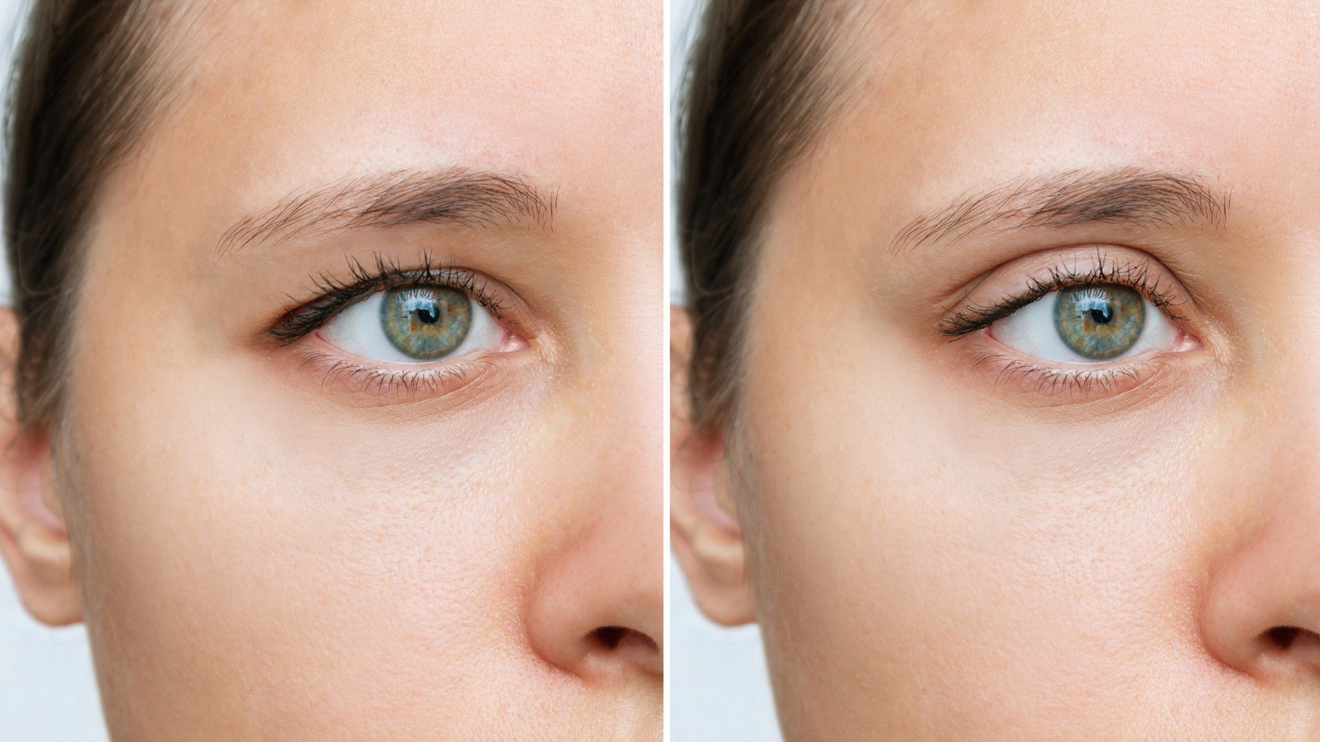 Oculoplastic Surgery — Tupelo, MS — Tupelo Eye Center Oculoplastic Surgery — Tupelo, MS — Tupelo Eye Center