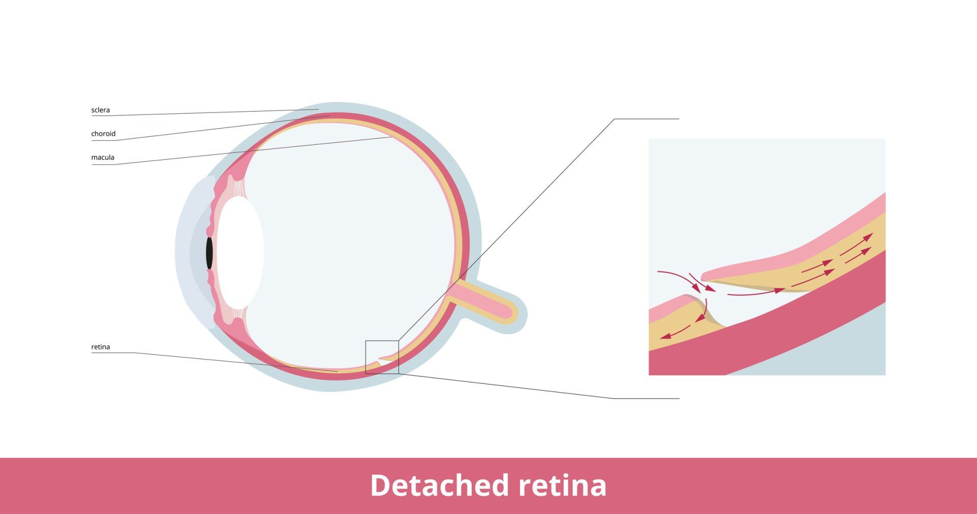 Detached Retina — Tupelo, MS — Tupelo Eye Center Detached Retina — Tupelo, MS — Tupelo Eye Center