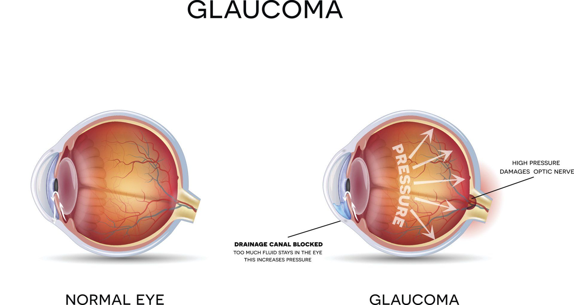 Glaucoma — Tupelo, MS — Tupelo Eye Center Glaucoma — Tupelo, MS — Tupelo Eye Center