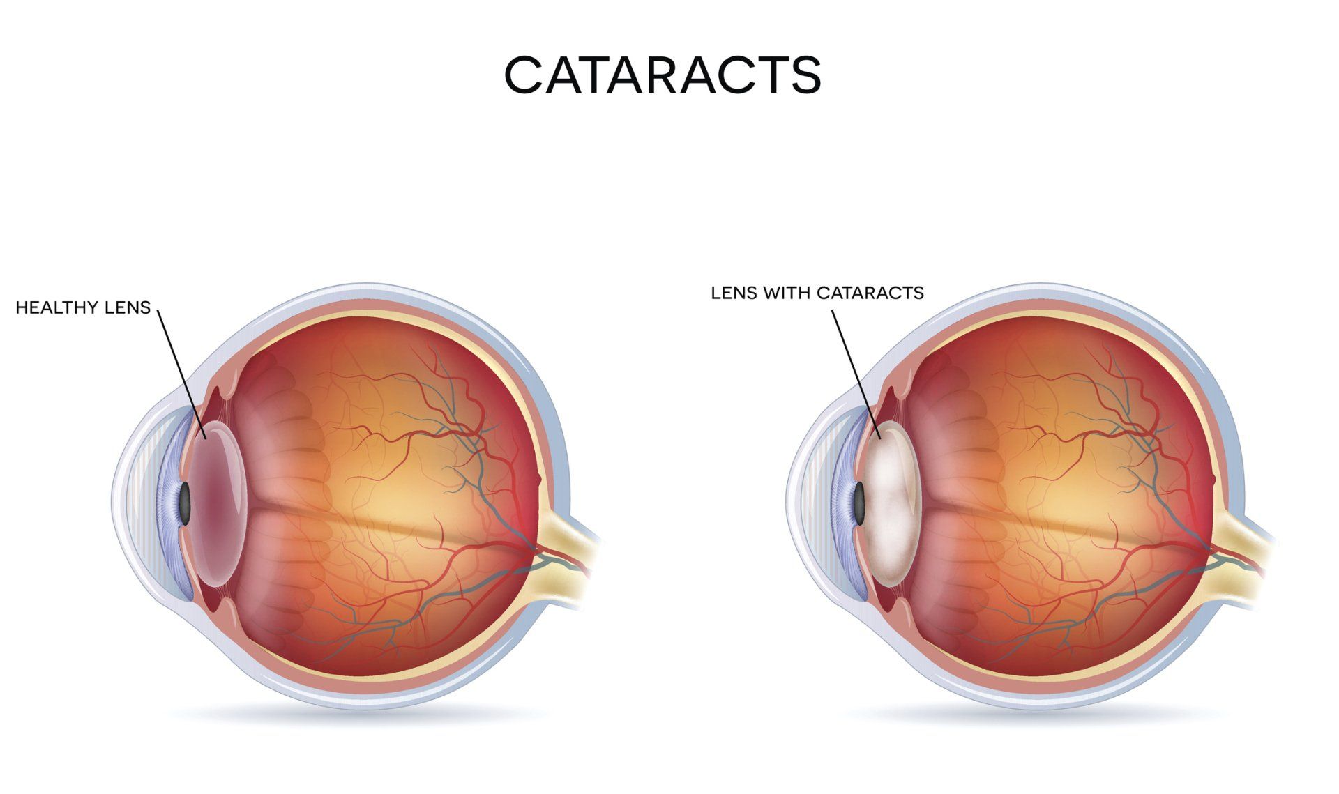 Cataracts — Tupelo, MS — Tupelo Eye Center Cataracts — Tupelo, MS — Tupelo Eye Center