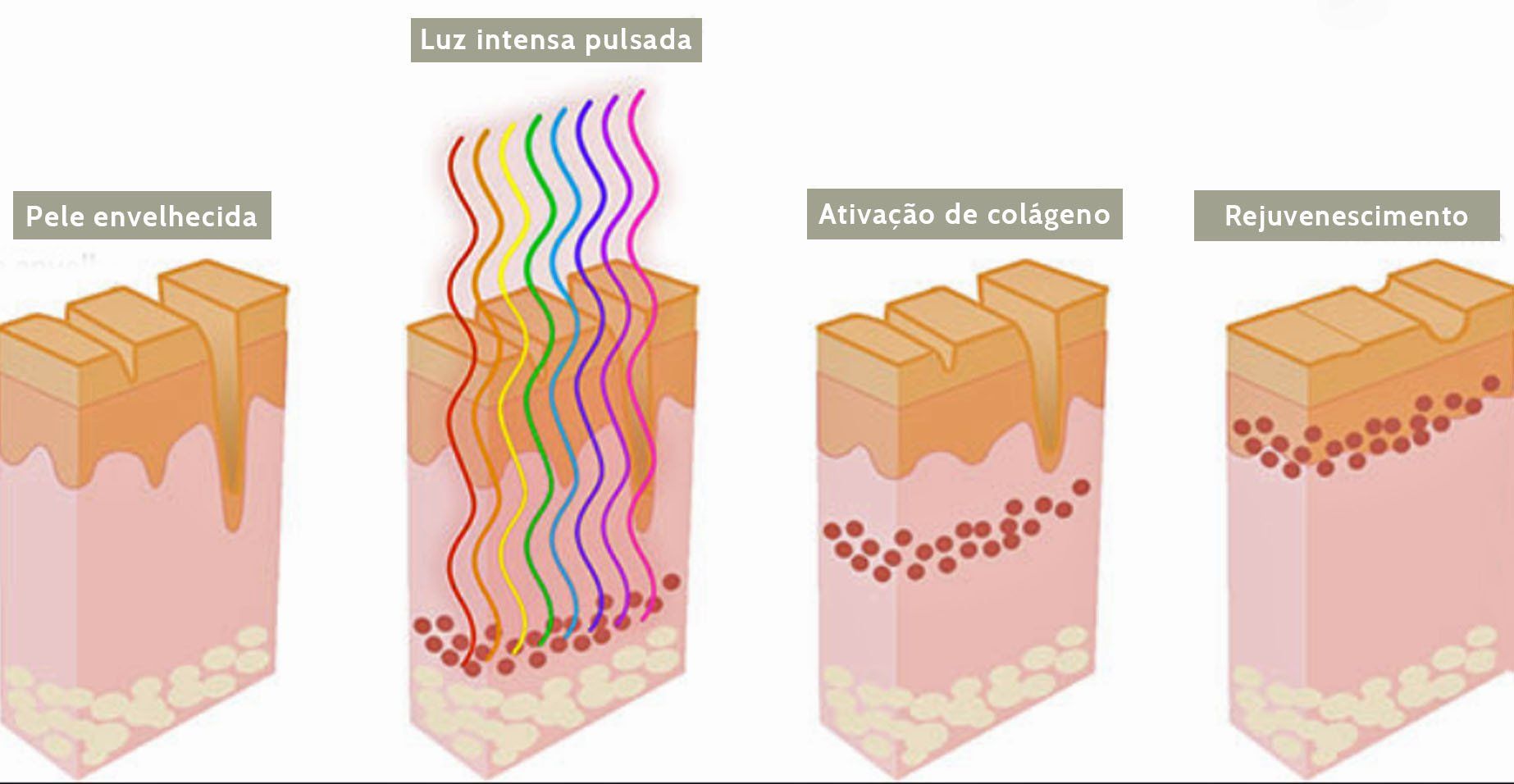 Um diagrama das diferentes camadas da pele