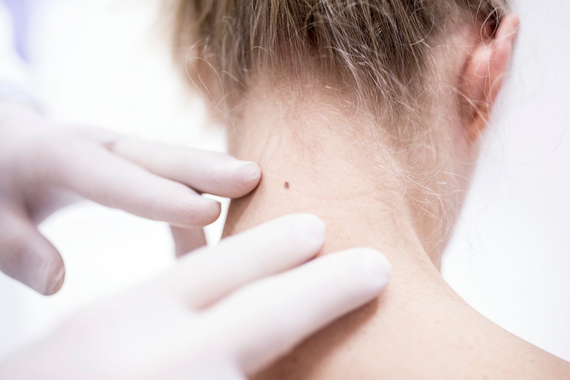 Mani guantate di un medico che esaminano un neo sul collo di una persona.