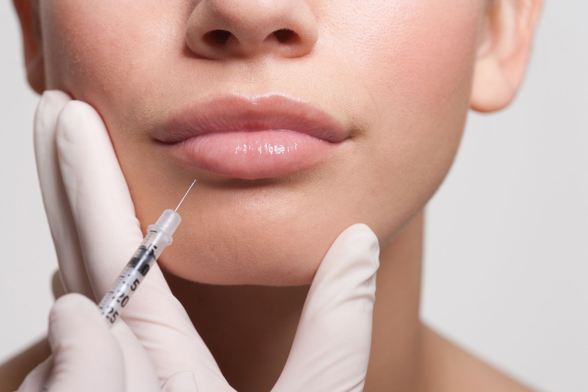 Le labbra di una persona che riceve un'iniezione di filler dermico, tenuta da una mano guantata.