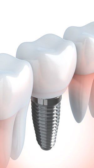 Implants