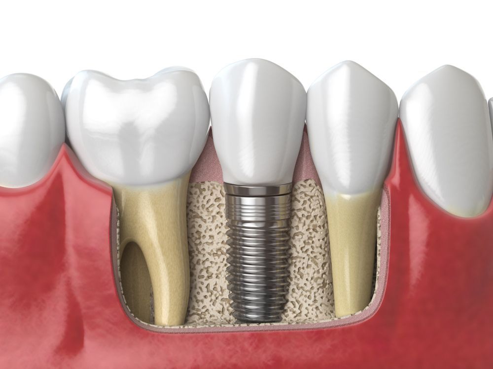 A computer generated image of a dental implant in a tooth.