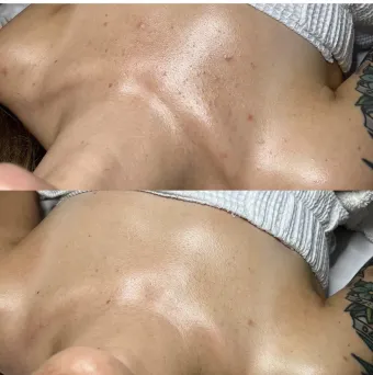 Two close-up views of a bare back with small dark spots on the skin.
