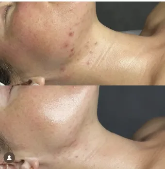 Close-up of neck skin with small red bumps and a smoother after-treatment comparison below.