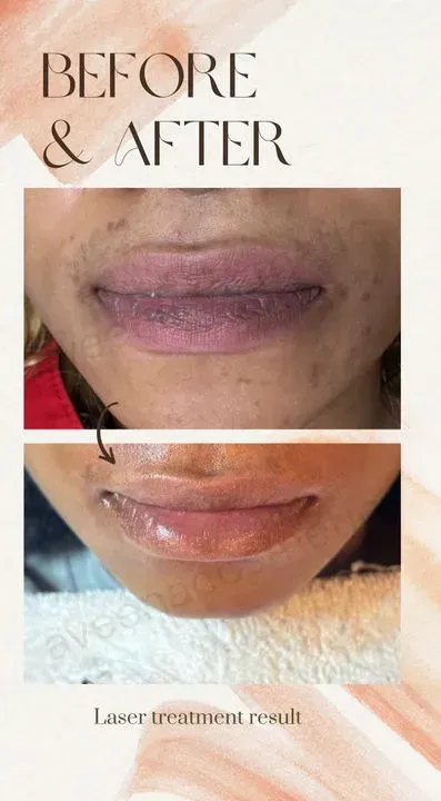 Before-and-after close-up of lips showing hyperpigmentation and lighter, even tone after laser treatment.