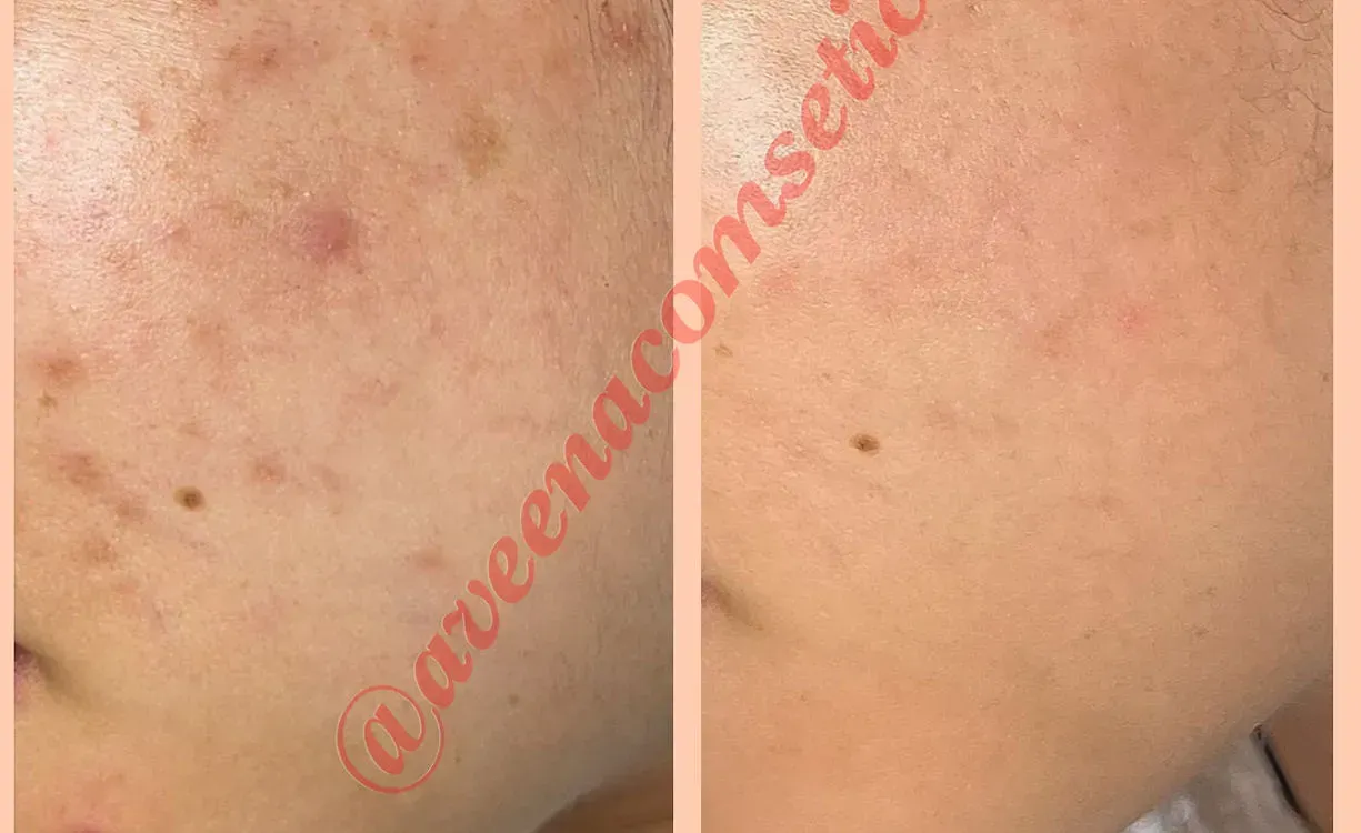 Side-by-side close-up of skin with small reddish spots and mild discoloration.