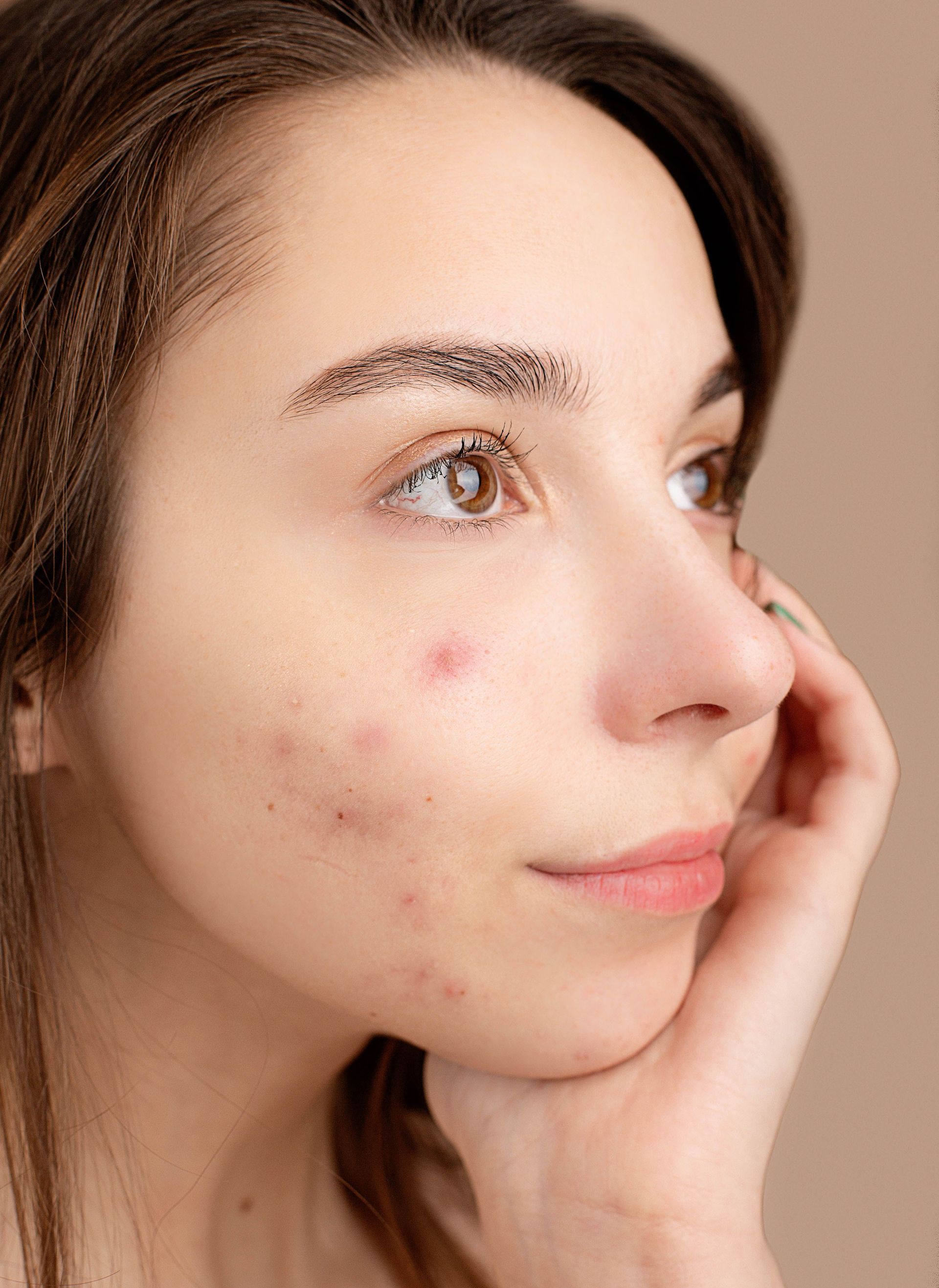 Close-up of a person touching their cheek, with visible acne spots and a neutral expression.