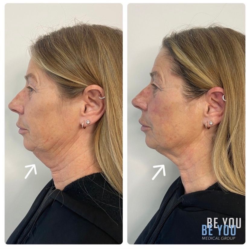1 treatment