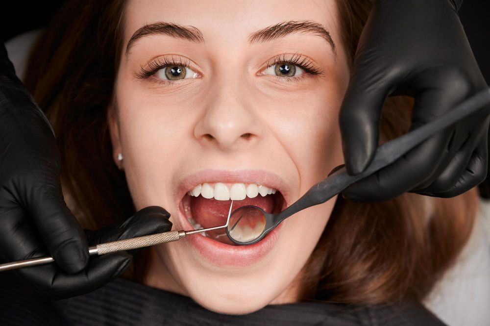 Composite Fillings
