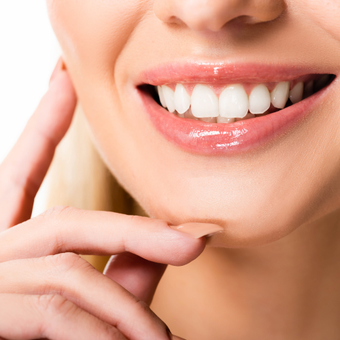 Veneers