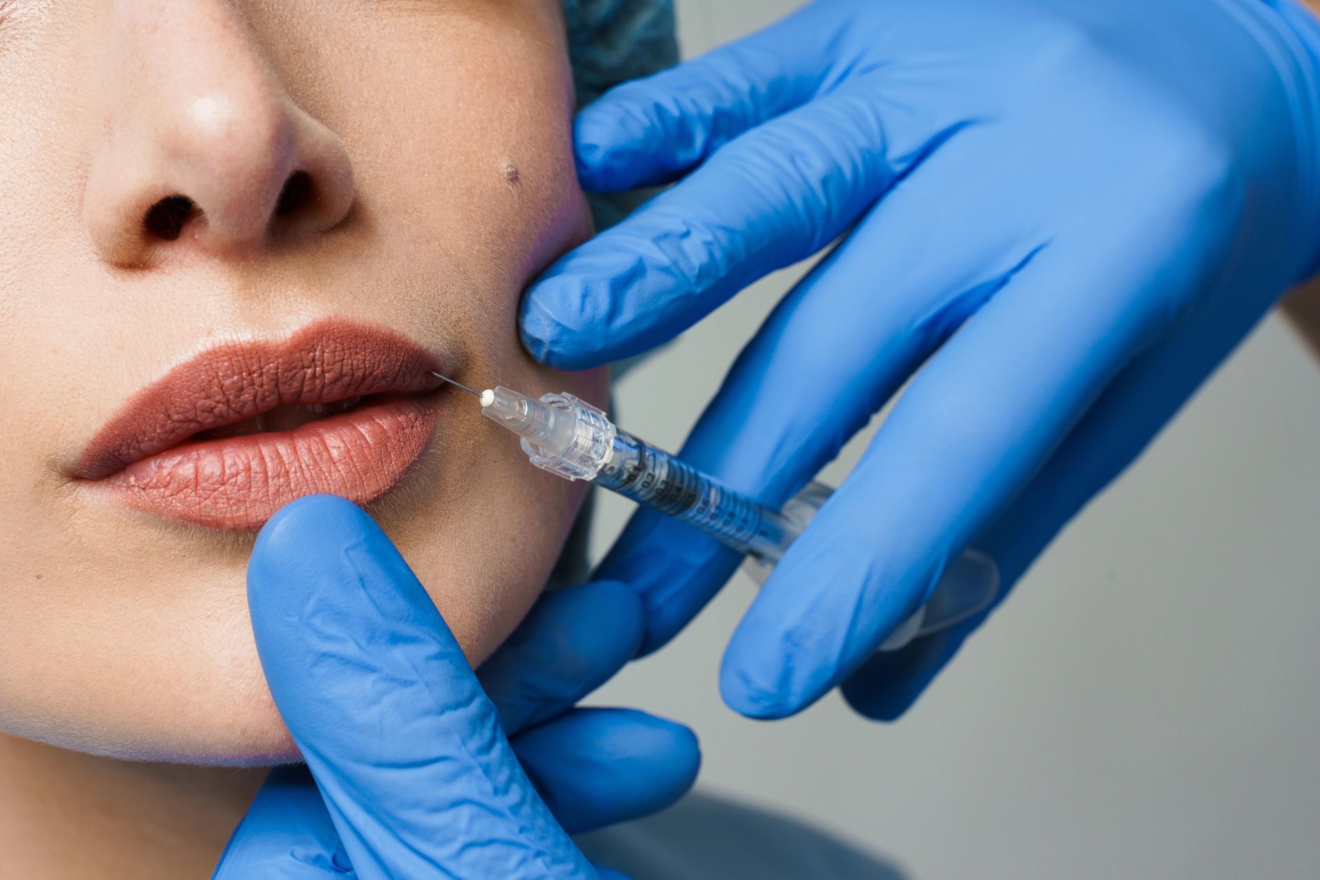 Mani guantate che iniettano filler nel labbro di una persona con una siringa
