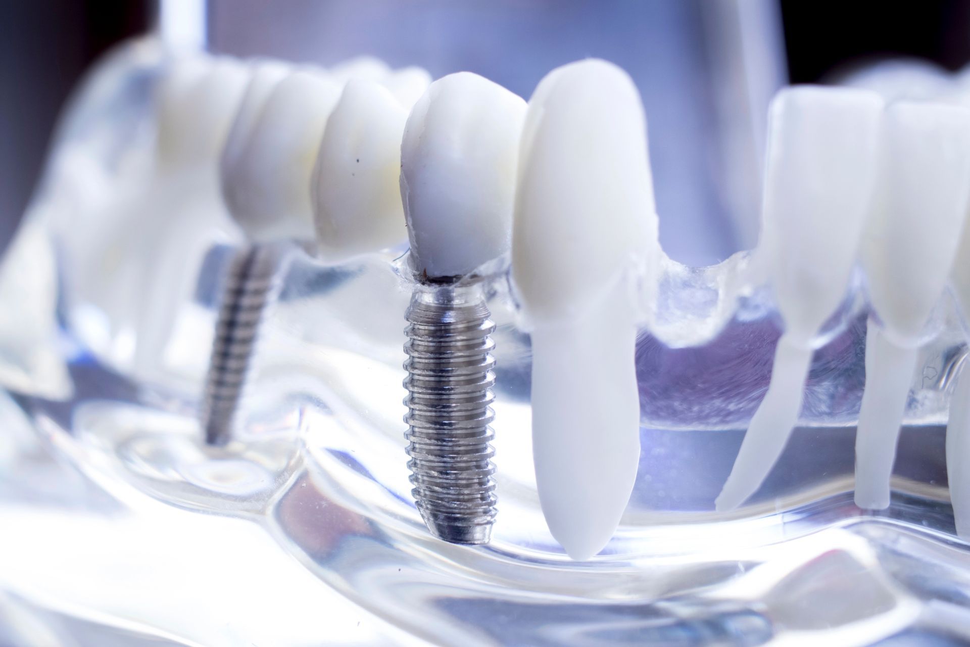 Impianti dentali con corone bianche su un modello trasparente di denti