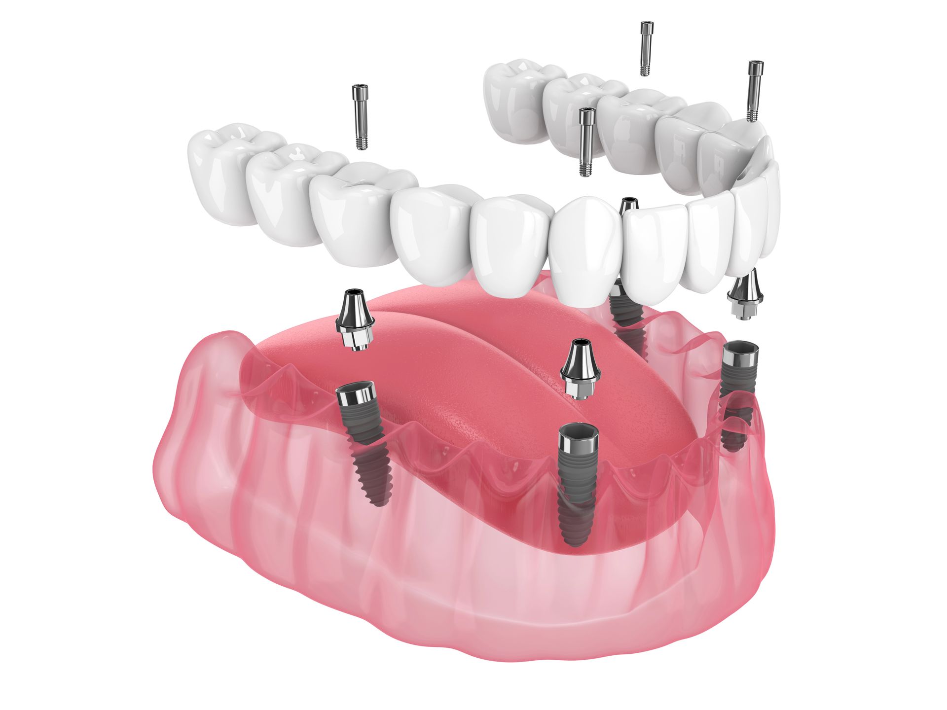 Modello di impianto dentale con denti bianchi e base gengivale rosa, che mostra i perni impiantati e i componenti del ponte rimovibile