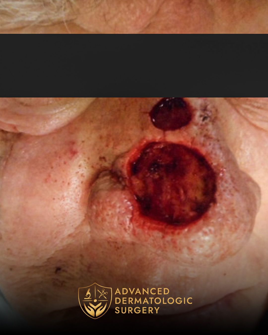 Mohs surgery on the nose at dvanced Dermatologic Surgery